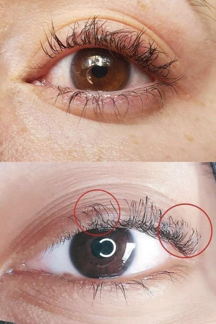 Corrección Profesional Lifting, imagen 1 de 3